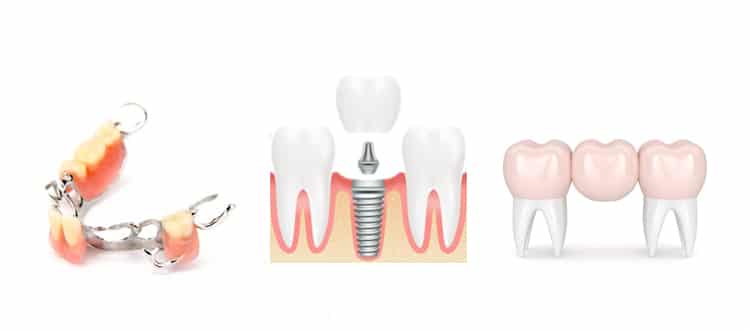 Tooth replacement