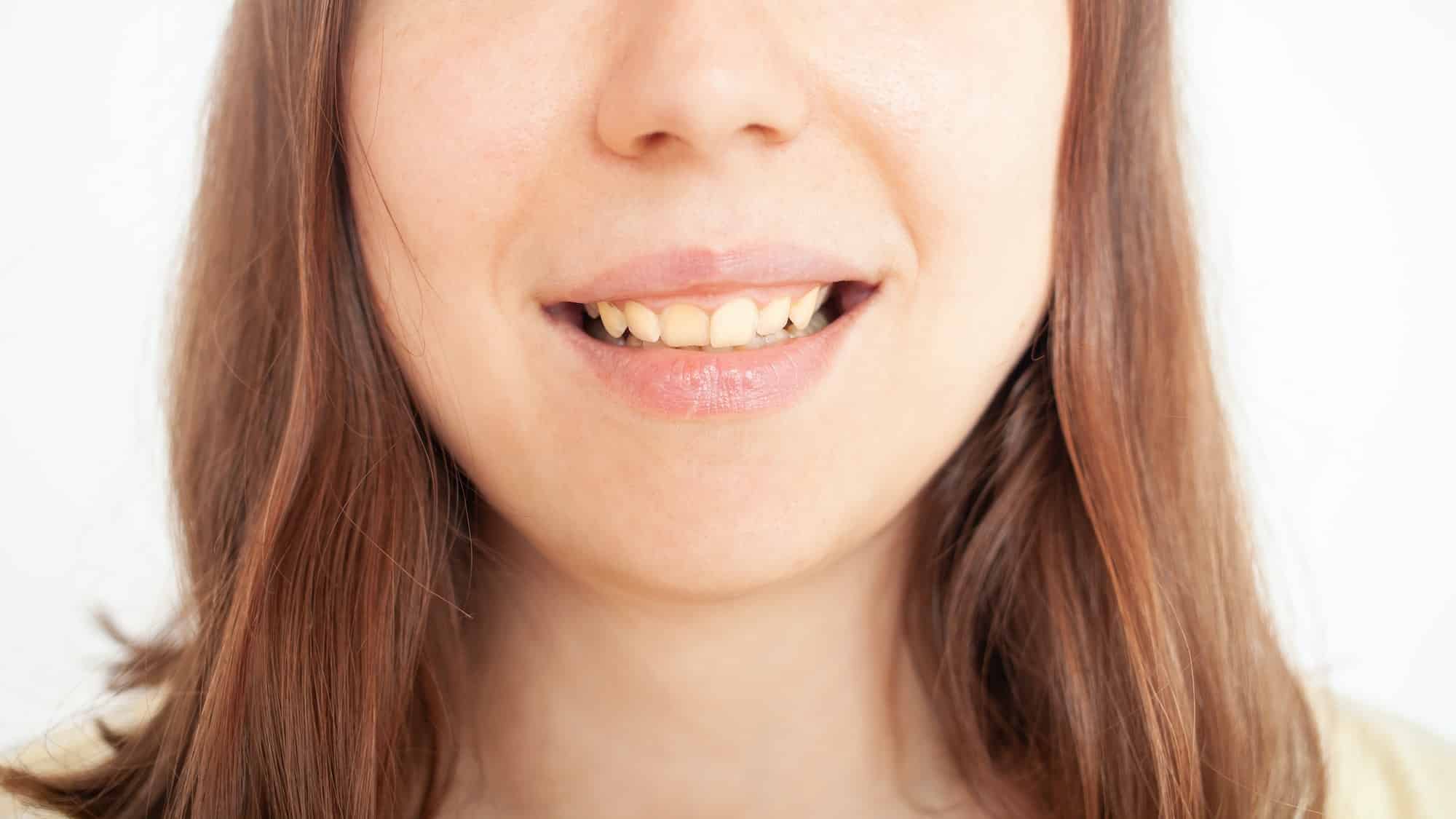 person smiles, shows teeth, yellow plaque, crooked teeth, malocclusion. woman shows gums